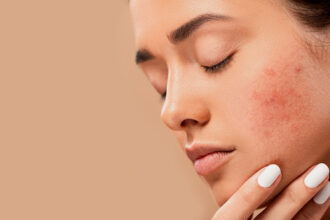 Acne Treatment Vienna