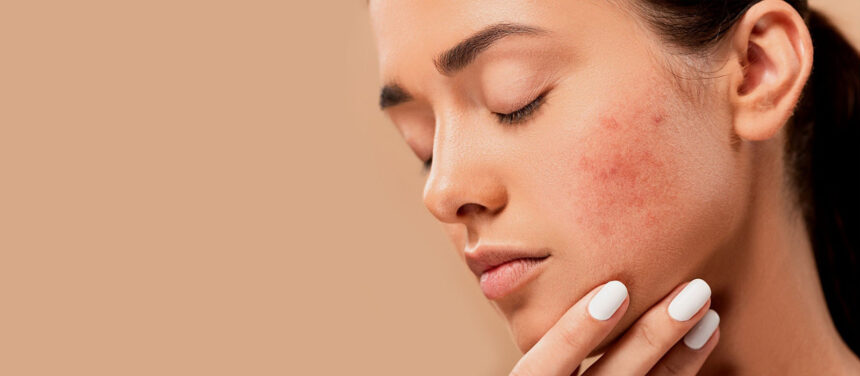 Acne Treatment Vienna