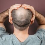 From Balding to Bold: The Power of Hair Transplants in Restoring Confidence