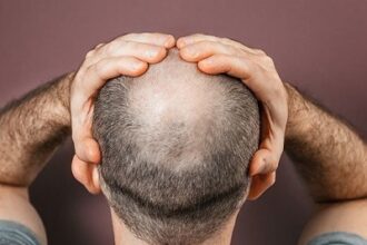 From Balding to Bold: The Power of Hair Transplants in Restoring Confidence