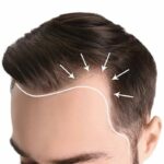 Understanding Hair Transplant Costs: What’s the Price Tag?