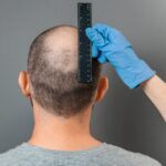 How does PRP Hair Treatment treat crown baldness?